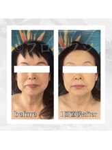 フローフシ∞/【小顔】70代女性症例写真