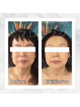 フローフシ∞/【小顔】70代女性症例写真