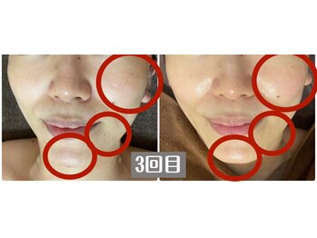 オレンジ(Orange)/[美白・エイジングSP]3回目写真