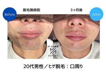 サロンアメリ イオンモール綾川店(Salon Ameri)/香川　脱毛　メンズ脱毛