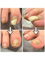爪のいろは&nbsp;ジェルをつけてから数ヶ月放置…巻き爪のリスクが高まります！