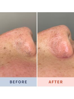 ソリス ビューティー(SOLIS BEAUTY)/毛穴洗浄