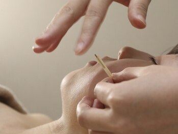 ラビィ(lovie)/小顔効果◎美容鍼