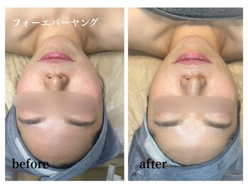 オトサロン(Otosalon)/シワ タルミ エイジングケア