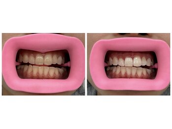 コナホワイトニング 神保町/ホワイトニング