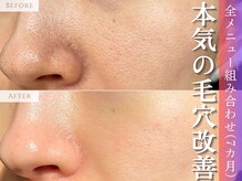 アポシェ(apoche)の雰囲気（毛穴開き改善◎庭瀬/問屋町/北長瀬/中庄/妹尾/大福/花尻/延友）