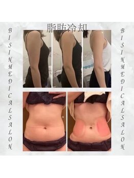 ビシンメディカルサロン(BISIN MEDICAL salon)/冷却/冷却/冷却/冷却/冷却/冷却