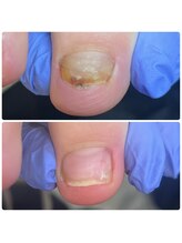 シュガーズネイル(sugar's nail)/トラブル爪ケア