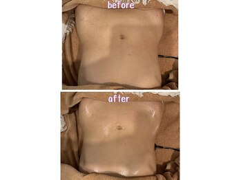 ラディアント(Radiant)/インディバ術後ケア/肌質改善