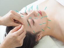 鍼灸治療院 ファイン(5N')/【肌奥からキレイに】美容鍼体験