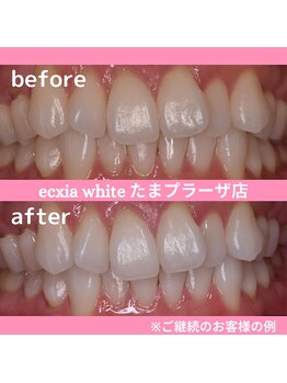 エクシアホワイトニング たまプラーザ店/ビフォーアフター