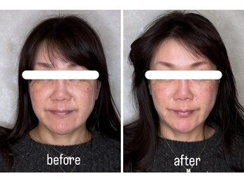 ウル 名駅(ulu)/美容鍼のビフォーアフターです♪