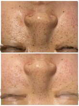 イリゼ(iriser)/プラズマ×ハーブピーリング