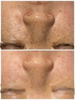 イリゼ(iriser)/プラズマ×ハーブピーリング