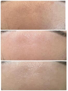 ミピブ 梅田(mipibu)/プラズマニキビ、毛穴、透明感