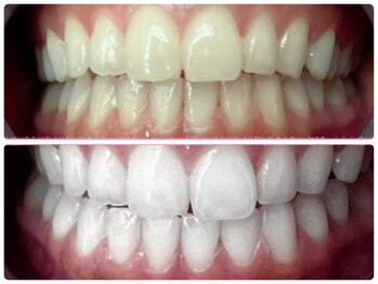 コナホワイトニング 神保町/ホワイトニング