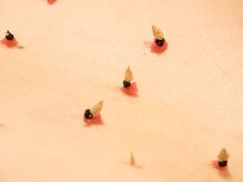 仙灸堂/最高級もぐさを使った贅沢なお灸