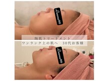 ルアナインフィニティ(Luana∞)の雰囲気（剥離なし、ダウンタイムなし♪即メイクOK!つるんとむき卵肌へ☆）