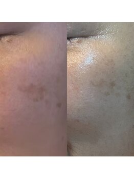 エラ(ella)/５０代　シミケア・肝ぱんケア