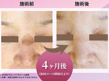 花蔵クール 金沢店/【コース開始4か月経過時点】