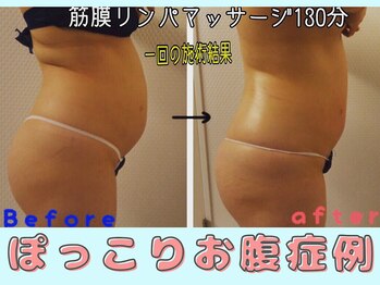 プレフィール(PLEAFEEL)/ぽっこりお腹症例