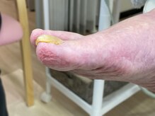 フットメンテ 巻き爪矯正センター 南浦和/肥厚爪施術前