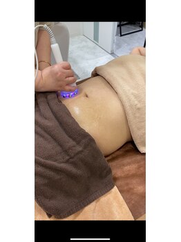 美フレイン/ラジオ波(高周波)