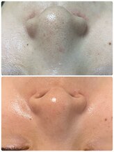 マリアム(mariam)/毛穴エクストラクションの効果