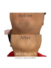 プランツ(PLANTS)/メンズ髭脱毛