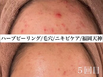 ホワイトアクア 福岡天神店(WHITE AQUA)/ハーブピーリングビフォー