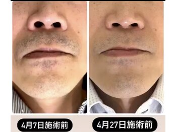 ピンクマジック(PINKMAGIC)/ヒゲ脱毛ビフォアフ