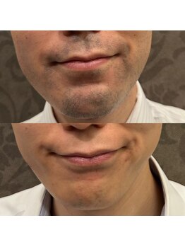 フェリーバ 流山店(FELIVA)/荒れる前に脱毛。