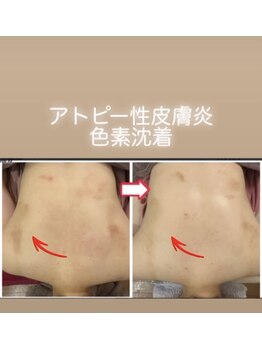 アンプリール(emplir)/色素沈着、肌のくすみ