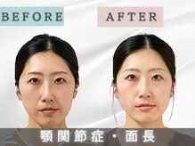 エルシンメトリー矯正院(ailesシンメトリー矯正院)/面長ビフォーアフター