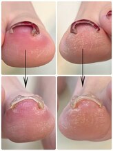 名古屋駅前巻き爪センター/巻き爪