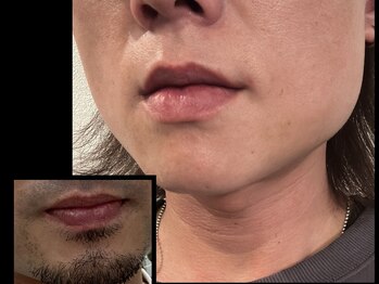 スムース イー(Smooth+E)の写真/【メンズ特化】高槻の都度払いヒゲ脱毛＆毛穴洗浄のできるサロン。男子もヒゲ　毛穴に悩まずツルツル肌に◎