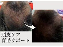 アルト(ALTO)の雰囲気（メンズの悩み！育毛促進サポート３ヶ月後の変化！）