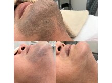 男性人気No.1【ヒゲ脱毛】