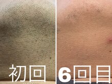 ニコ アンド キャンディー(Nico.&Candy)/ヒゲ脱毛　本厚木/本厚木脱毛