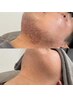 【肌印象UP！メンズ脱毛ご紹介制】髭脱毛 カウンセリング込み