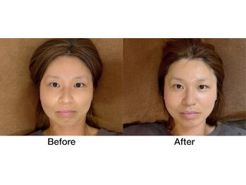 こじま 富雄団地接骨院/たるみ改善