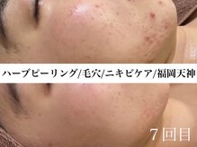 ホワイトアクア 福岡天神店(WHITE AQUA)/ハーブピーリングビフォー