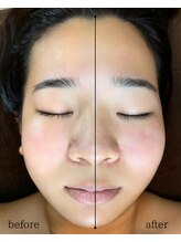 アノネ(Anone.)/バザルトヘッド　リフトアップ