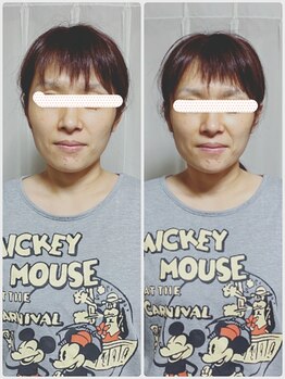 チチ(Chichi)/フェイスラインがスッキリ！