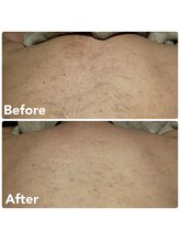 シェア(SHARE)/メンズ全身脱毛（背中）1回目