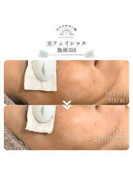 エステサロン朝/光フェイシャル