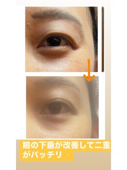 ハーモニー(Harmony)/瞼切ったり縫ったりする前に！！