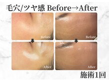 セレーノ 白金台(seReno)/サーマ×ララピールBeforeAfter