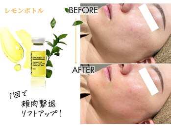 キレイベース 銀座店(KIREI BASE)/レモンボトル 1回での変化