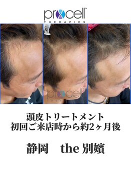 ザ ベッピン(the 別嬪)/頭皮は提携美容院にて施術可能